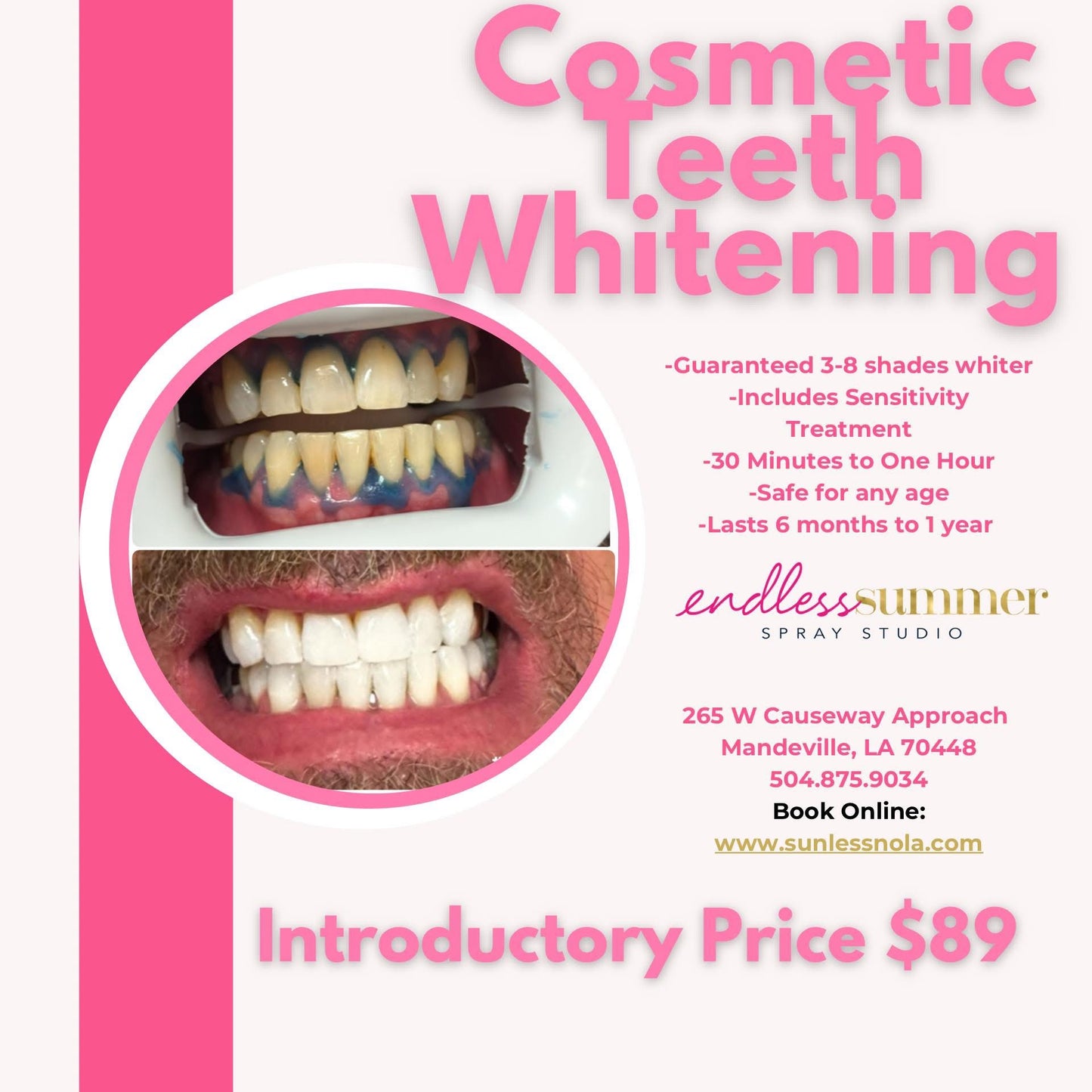 Bronze and Bright Sale - Teeth Whitening Session